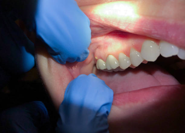 Best Emergency Tooth Extraction in Old Mystic, CT